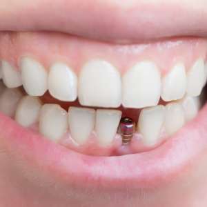 Dental Implants - Fioritto Family Dental