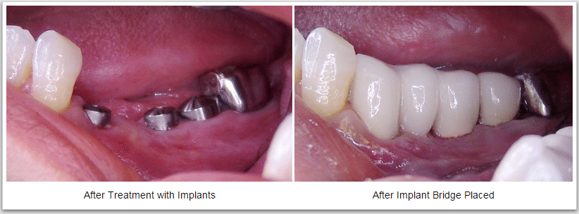 Dental Implants Picture