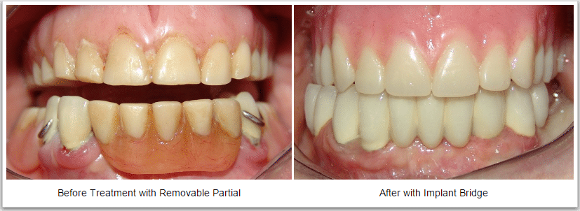 Dental implant bridge